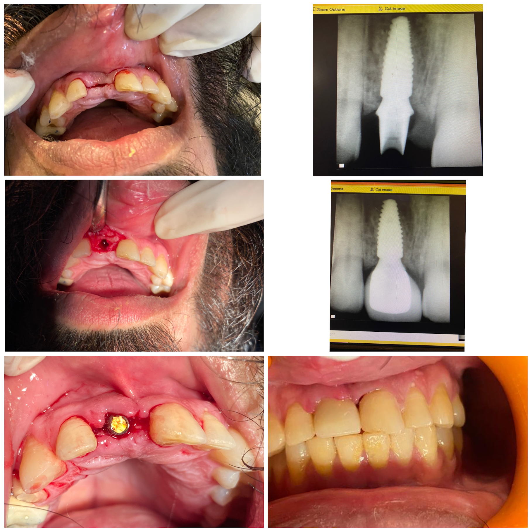 Real anterior dental implant case at Poly Dental Clinic Mohali — extraction, implant placement, healing, and final restoration with X-rays