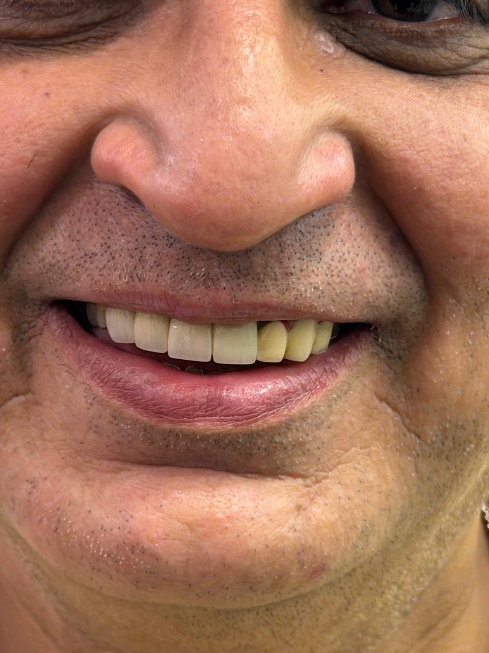Intraoral close-up of implant-supported ceramic restoration — natural bite and shade
