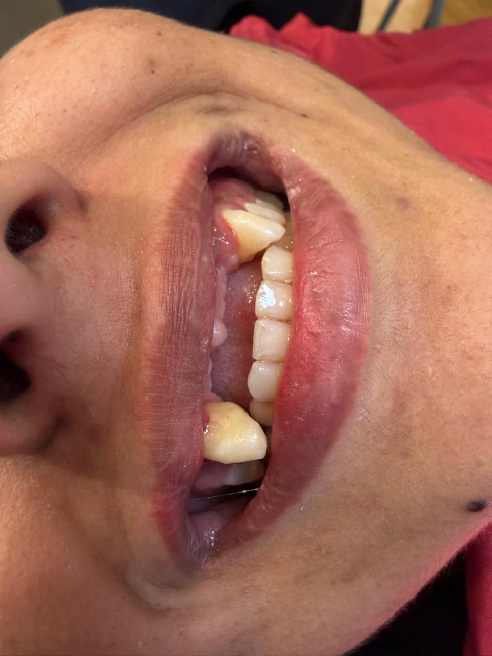 Intraoral view before treatment — broken upper anterior tooth with visible gap, Polydental Clinic Mohali
