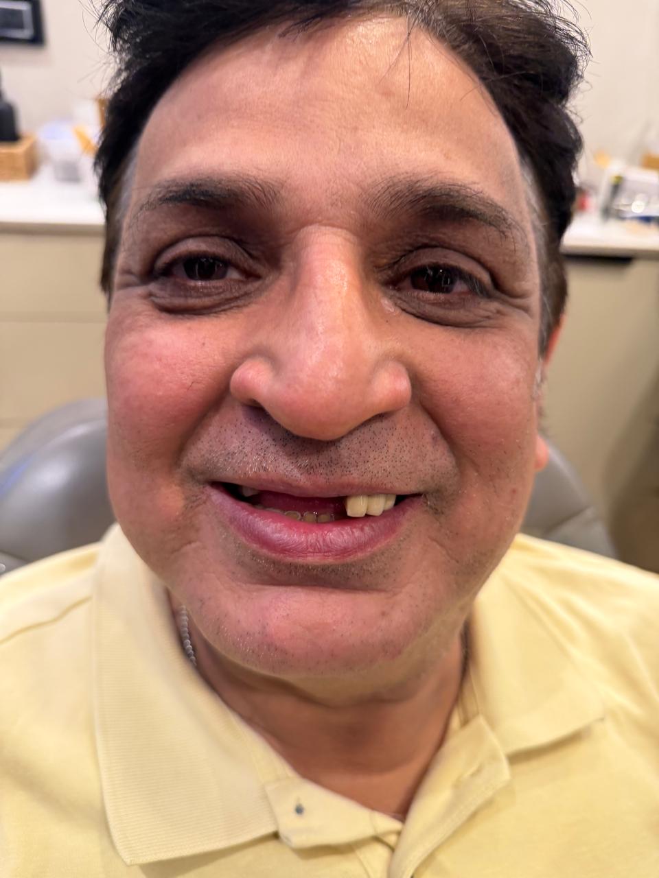 Intraoral view of titanium implant healing abutments in upper and lower jaw — osseointegration stage at Polydental Clinic Mohali