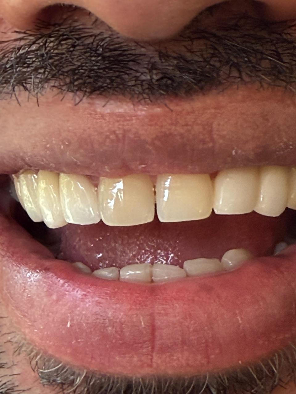 Polydental Clinic Mohali smile makeover result — aligned ceramic crowns on upper arch, natural shade match