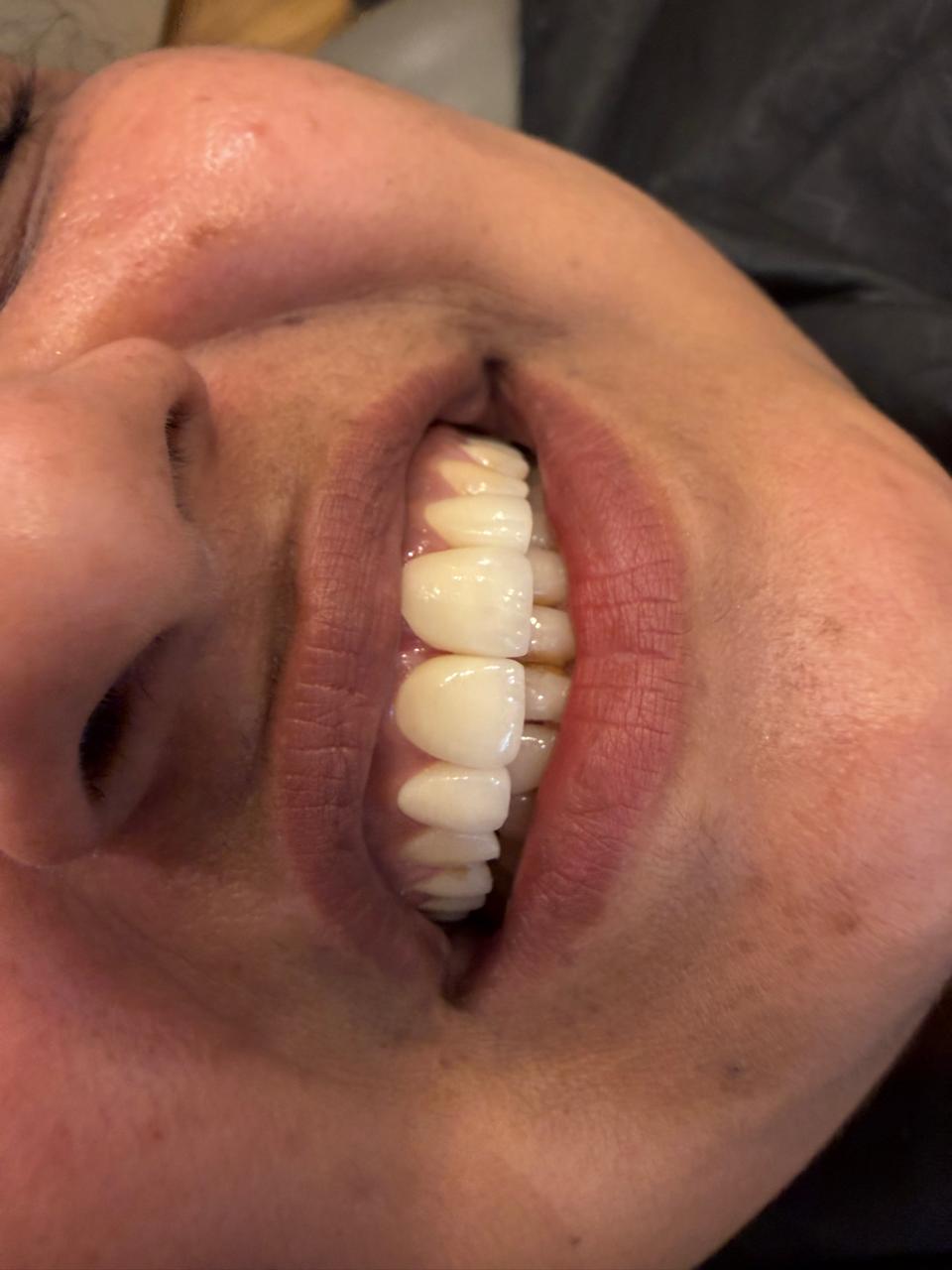 Same patient after professional ultrasonic scaling at Polydental Clinic Mohali — cleaner shade and clearer gumline