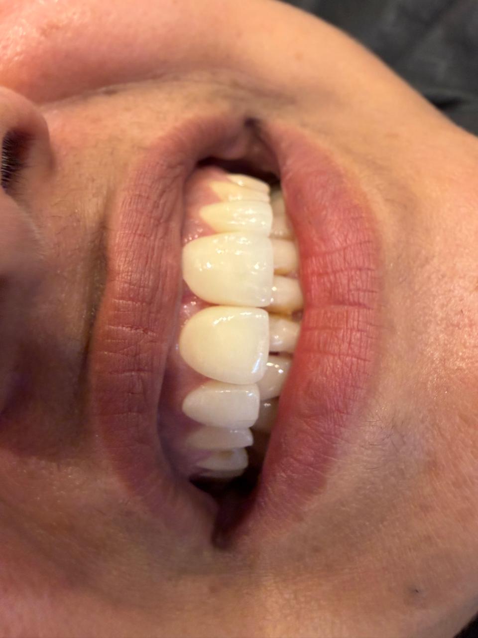Close-up of polished teeth after scaling — smoother surface and refreshed natural shade