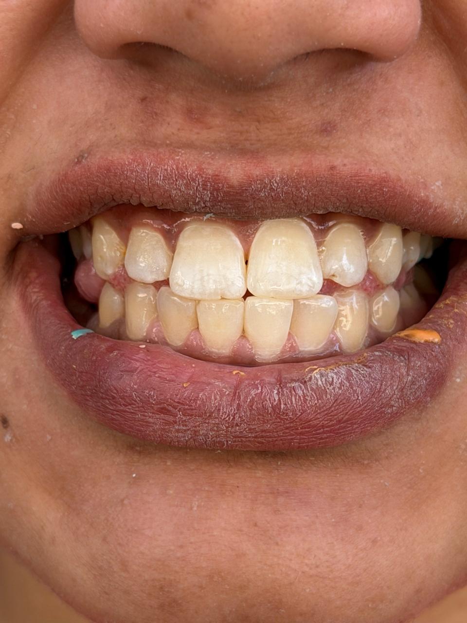 Polydental Clinic patient before professional scaling — stained teeth with visible plaque and discolouration