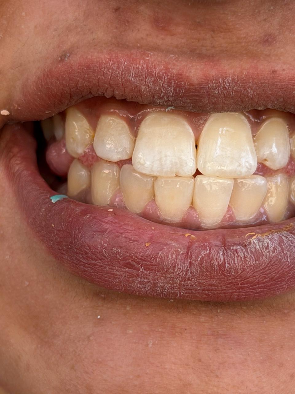 Close-up of plaque buildup and shade discolouration before scaling