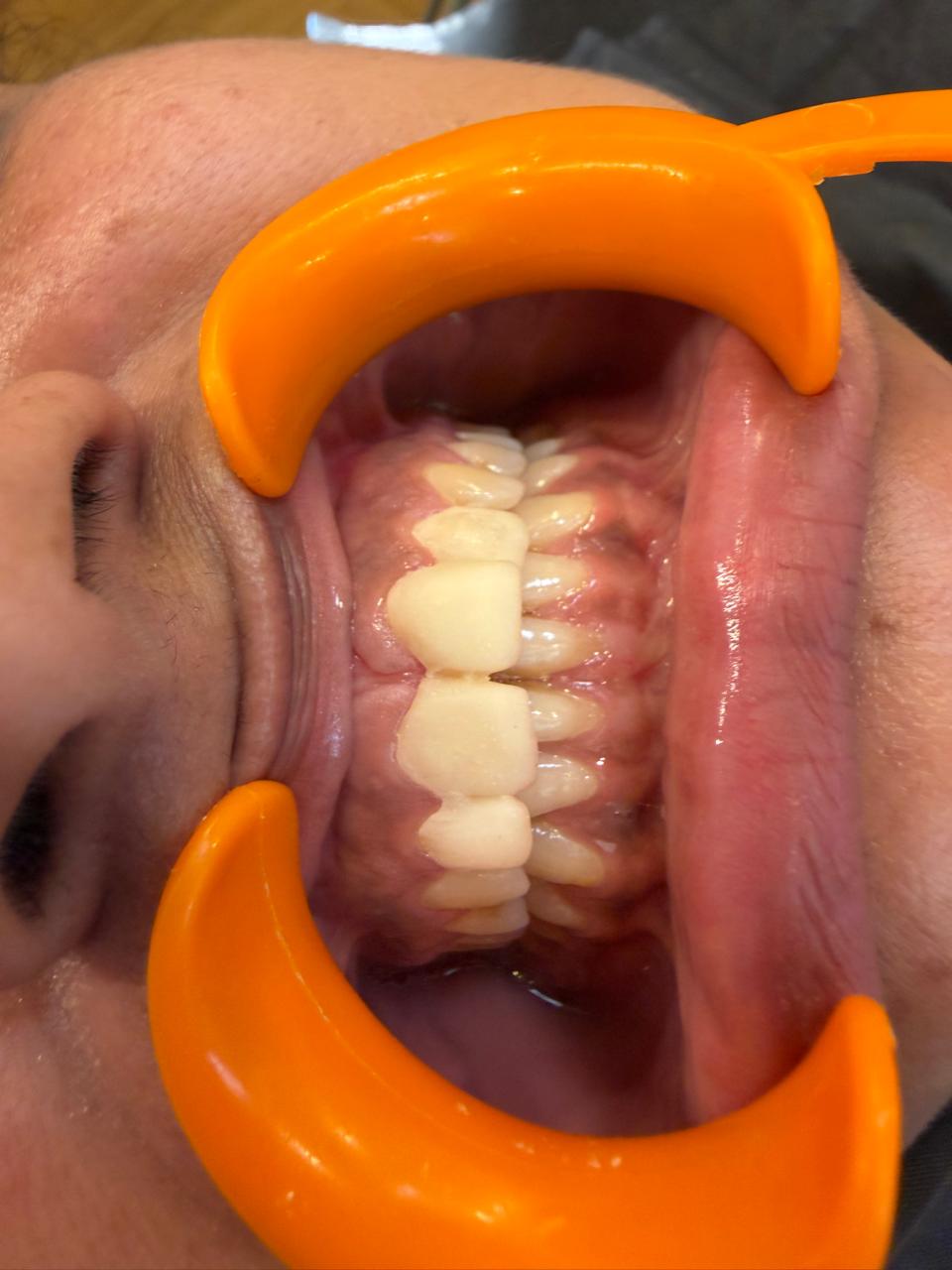 Intraoral close-up showing veneer-restored upper front teeth — Polydental Clinic Mohali