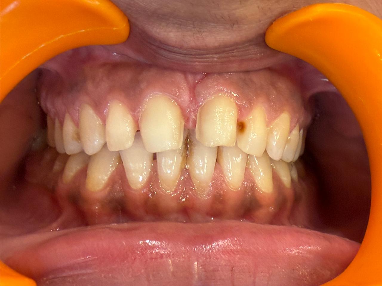 Polydental Clinic patient before ceramic veneers — visible staining and uneven upper teeth