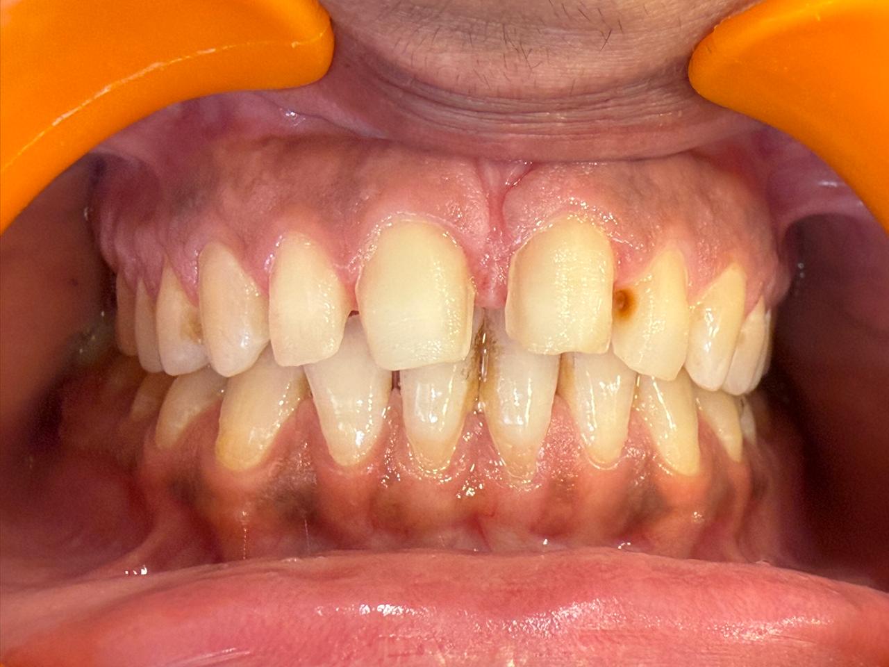 Intraoral close-up before treatment — discoloured front teeth and visible decay