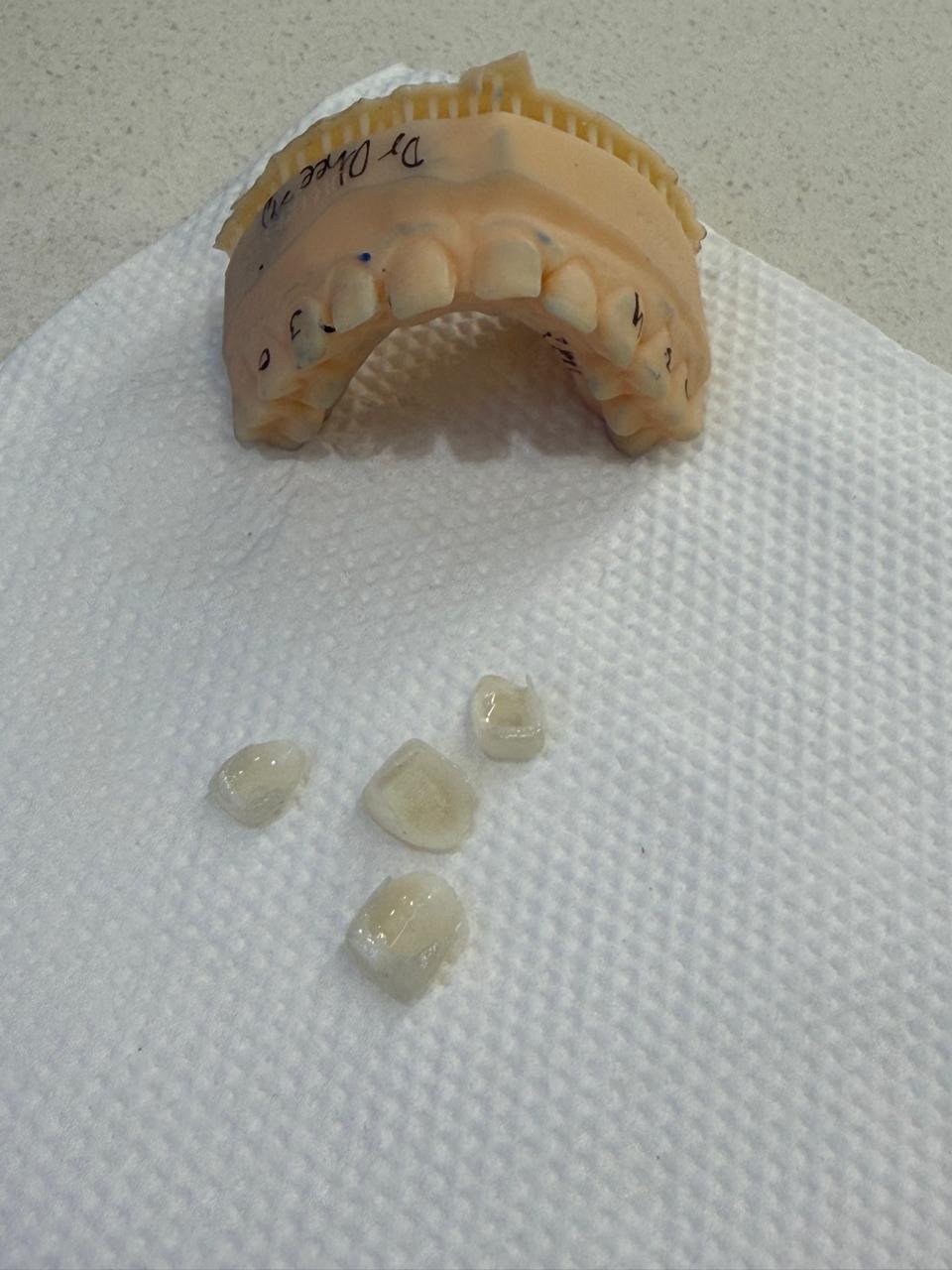 Custom ceramic crowns on dental laboratory model ready for fitting