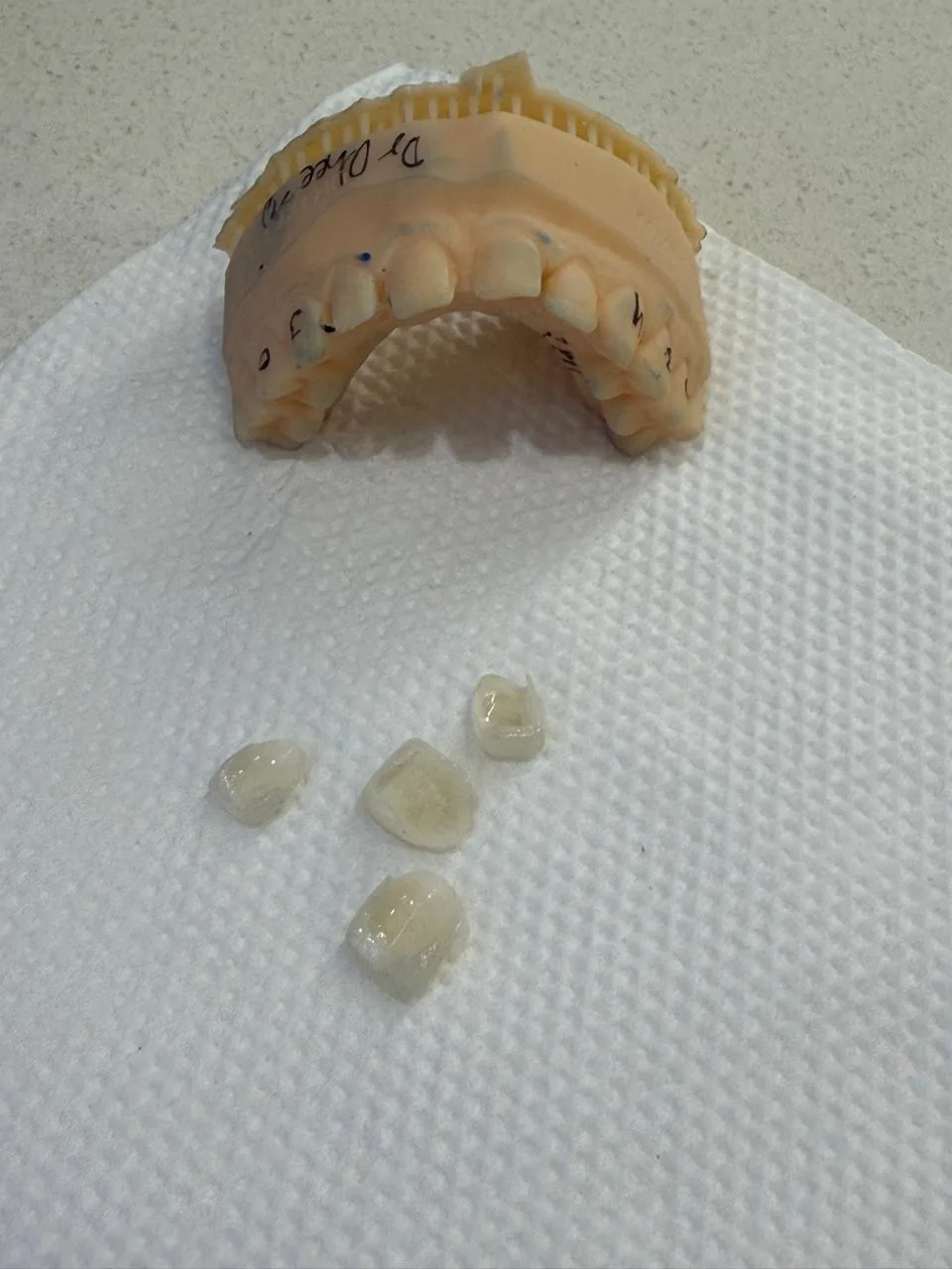 Porcelain Veneers